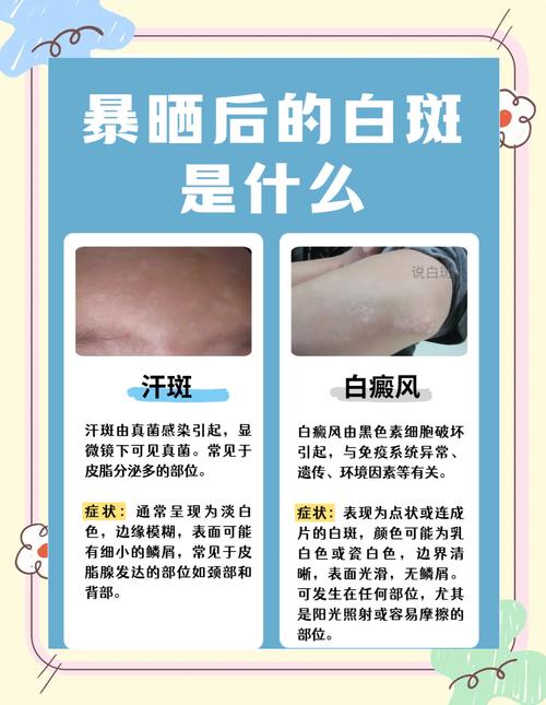 萎缩性白斑能治愈吗?,萎缩性白斑能治愈吗多少钱