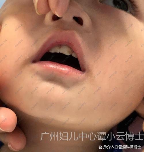 卡波西血管瘤有血流信号吗,卡波西型血管内皮瘤能完全治愈吗